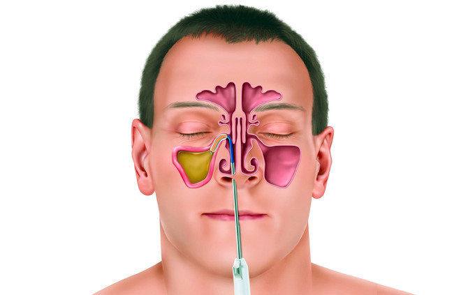 Πώς να καθαρίσετε εύκολα τους ιγμόρειους κόλπους σας!